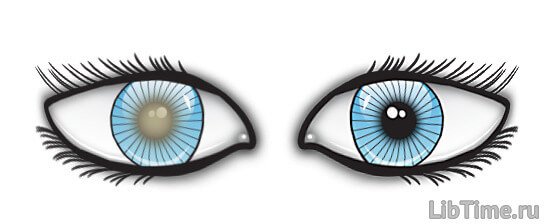 Cataract